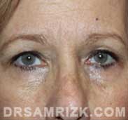 female photo before eyelid surgery