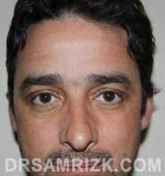 male photo after blepharoplasty