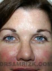 eyelid surgery before after photo