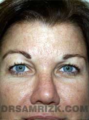 patient before Eyelid Surgery - front view