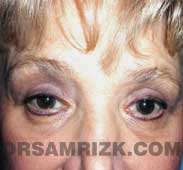 eyelid surgery blepharoplasty after pictures