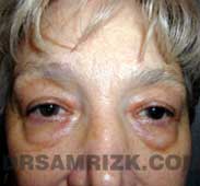 eyelid surgery blepharoplasty before after photo
