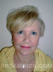female patient after blepharoplasty - image