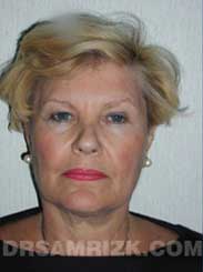 Female patient before Eyelid Surgery - pic