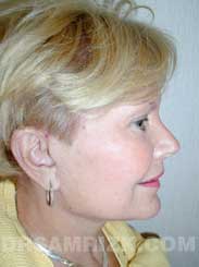 patient after Eyelid Surgery - image