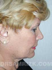 patient before Eyelid Surgery - image