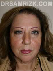 Female Preoperative blepharoplasty - photo