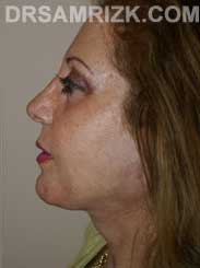 Female patient after Eye Surgery - pic