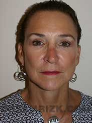 photo after upper and lower eyelift surgery
