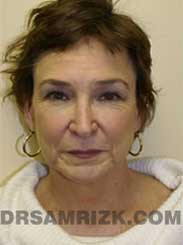 photo Female before eyelid-surgery