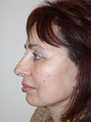 Facelift New York
