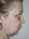 Facelift New York