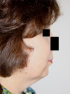 Facelift New York