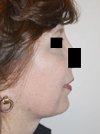 Facelift New York