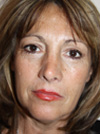 Facelift New York