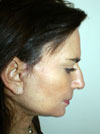 facelift before and after images