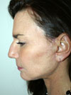facelift after photo