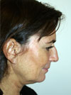 facelift before and after pictures