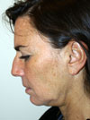facelift before photo