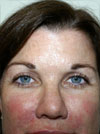Facelift NYC
