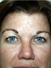 Facelift NYC