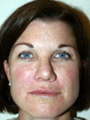 Facelift NYC