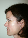 Facelift NYC