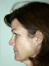 Facelift NYC