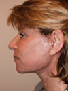 Laser Resurfacing New York