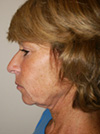 Laser Resurfacing New York