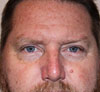 Eyelid Surgery NYC