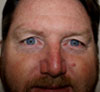 Eyelid Surgery NYC