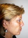 Facelift NYC