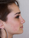 Nose Job NYC