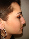 Nose Job NYC