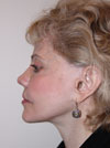 Facelift New York