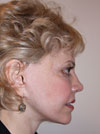 Facelift New York