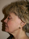 Facelift New York