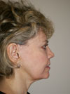 Facelift New York