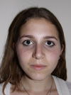 Nose Job NYC