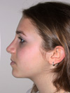 Nose Job NYC