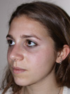 Nose Job NYC