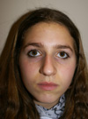 Nose Job NYC