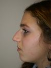 Nose Job NYC