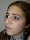 Nose Job NYC