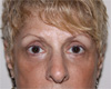 Eyelid Surgery NYC