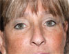 Eyelid Surgery NYC