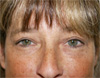 Eyelid Surgery NYC