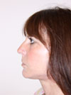 Facelift New York