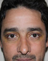 Eyelid Surgery NYC